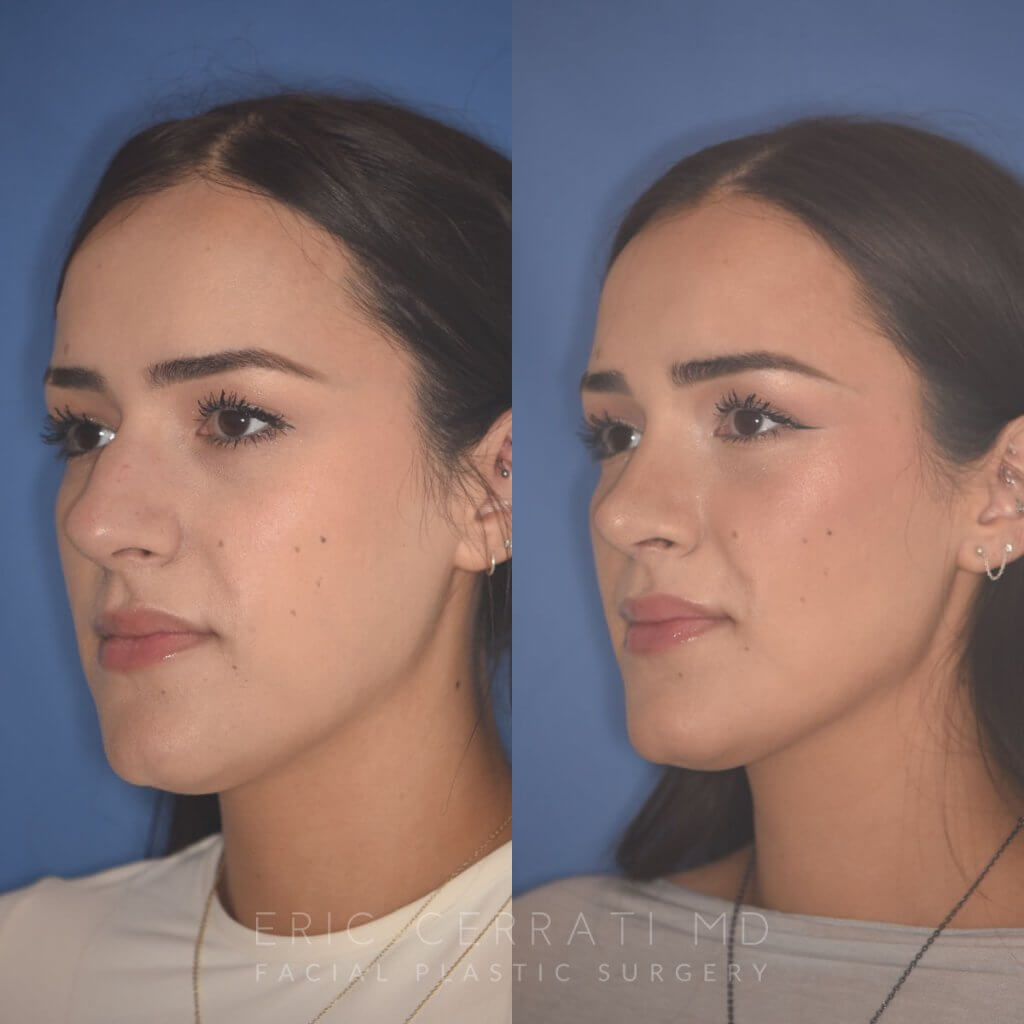 27 YR - 2 Months Postop: Rhinoplasty
