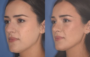 27 YR - 2 Months Postop: Rhinoplasty