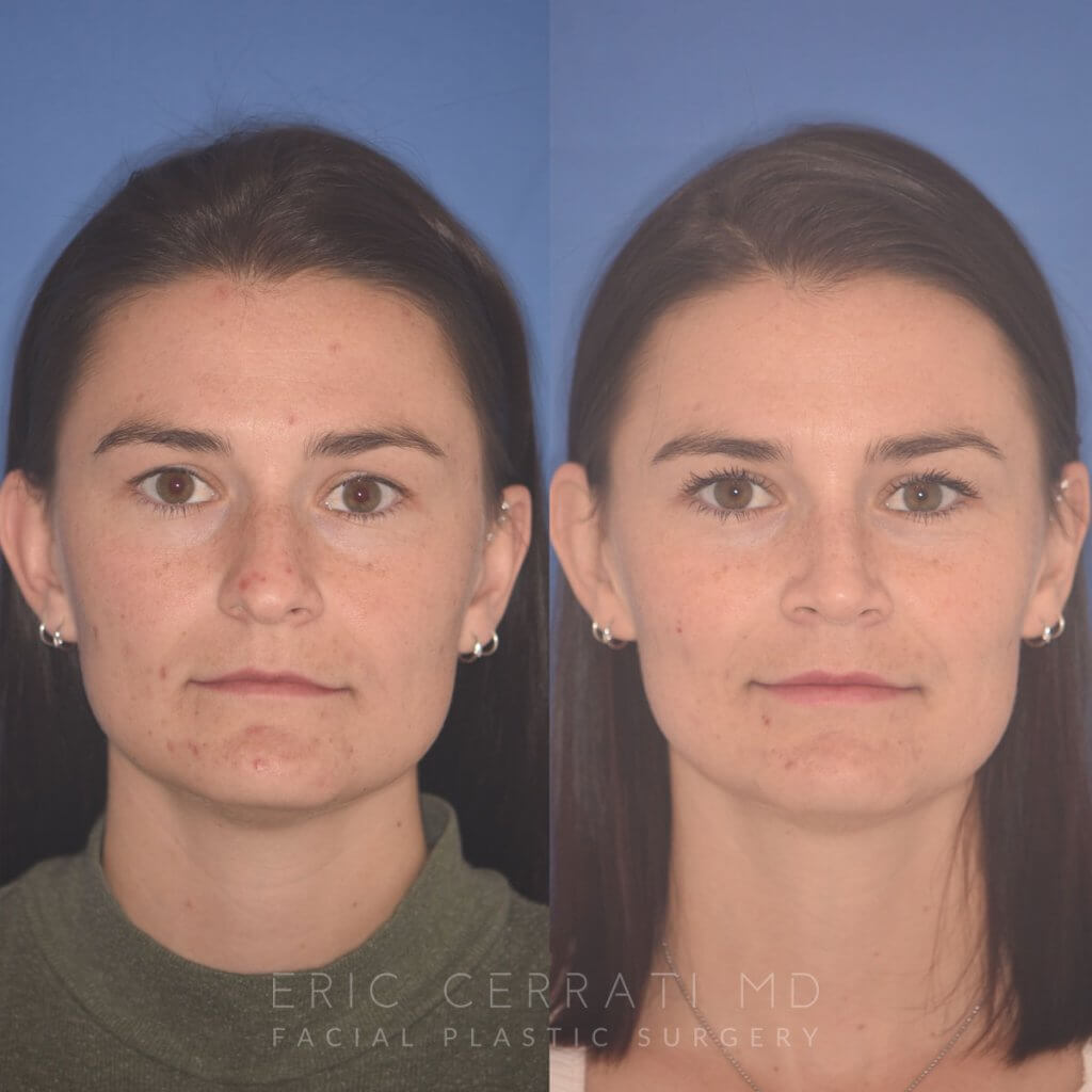 27 YR - 2 Months Postop: Rhinoplasty