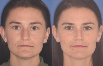 27 YR - 2 Months Postop: Rhinoplasty