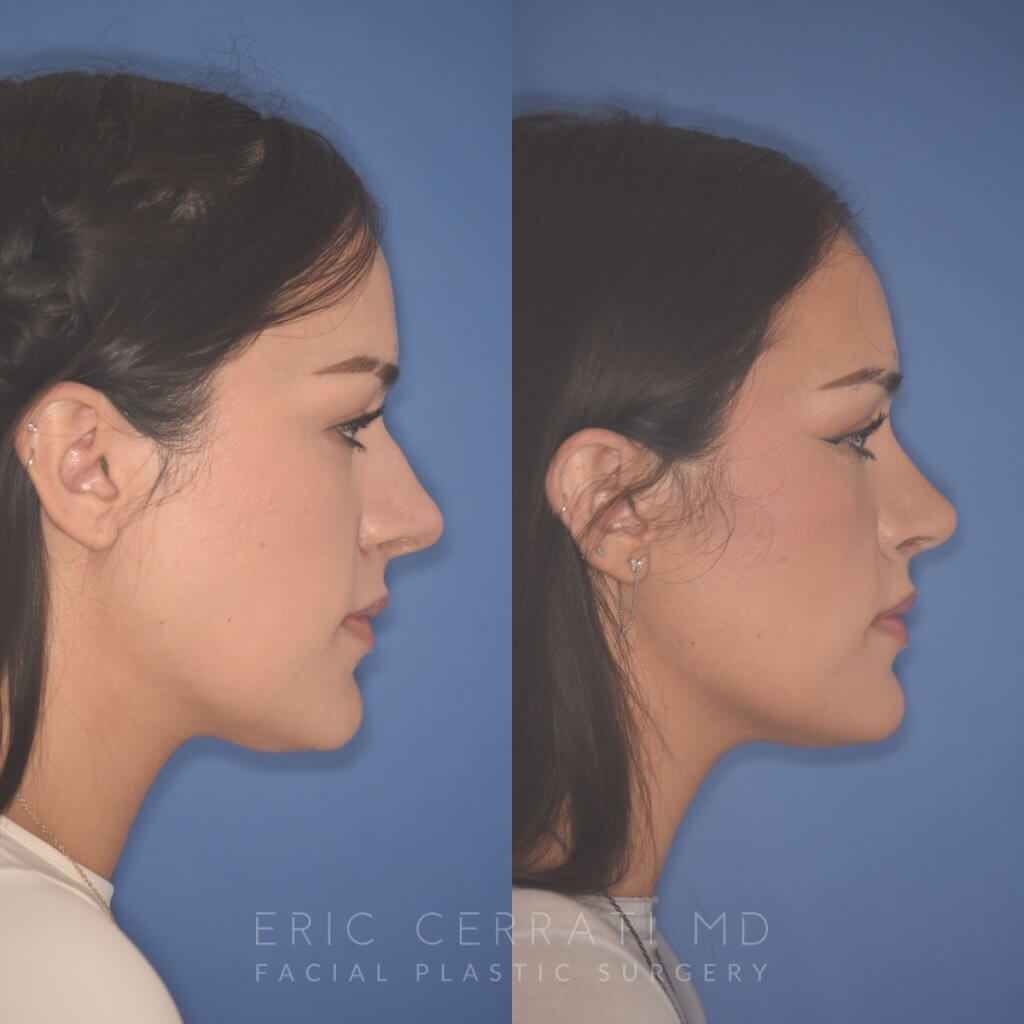 27 YR - 2 Months Postop: Rhinoplasty