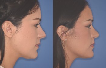 27 YR - 2 Months Postop: Rhinoplasty