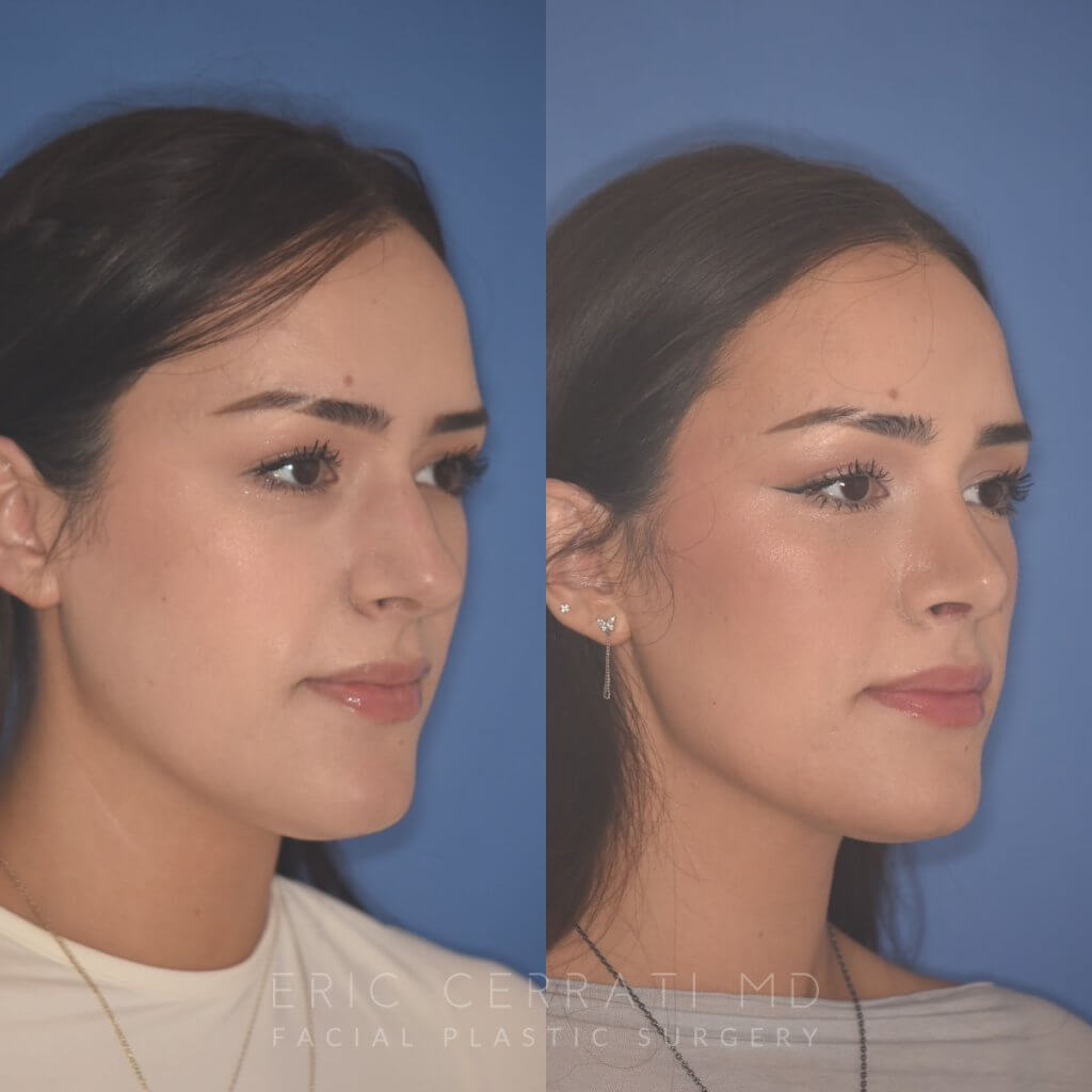 27 YR - 2 Months Postop: Rhinoplasty