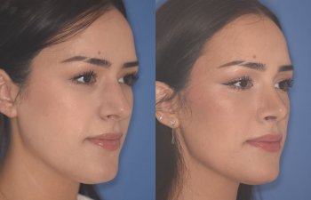27 YR - 2 Months Postop: Rhinoplasty