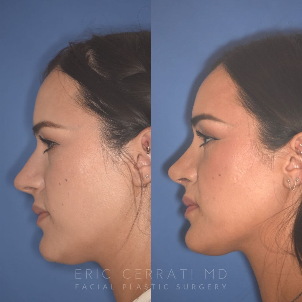 27 YR - 2 Months Postop: Rhinoplasty