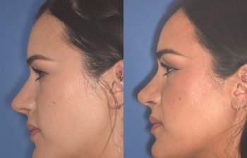 27 YR - 2 Months Postop: Rhinoplasty