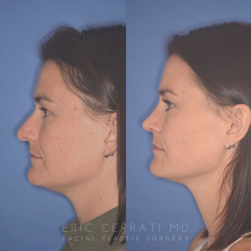 27 YR - 2 Months Postop: Rhinoplasty