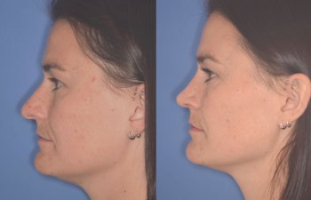 27 YR - 2 Months Postop: Rhinoplasty