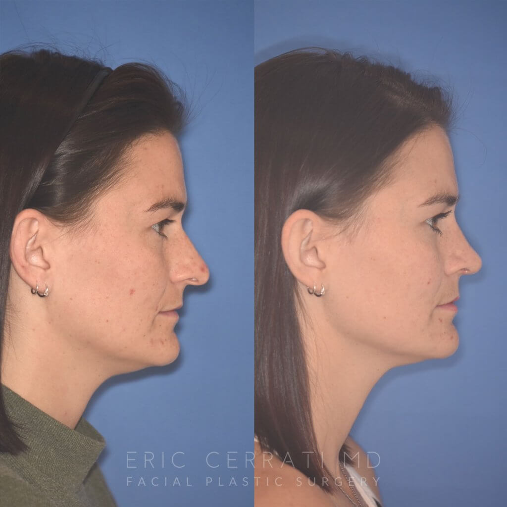 27 YR - 2 Months Postop: Rhinoplasty