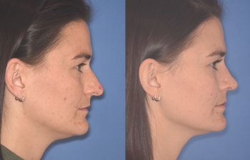 27 YR - 2 Months Postop: Rhinoplasty