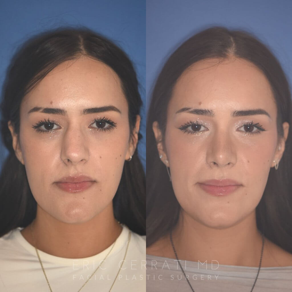 27 YR - 2 Months Postop: Rhinoplasty