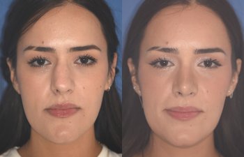 27 YR - 2 Months Postop: Rhinoplasty