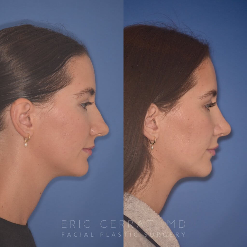 24 YR - 2 Months Postop: Rhinoplasty