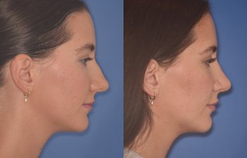 24 YR - 2 Months Postop: Rhinoplasty