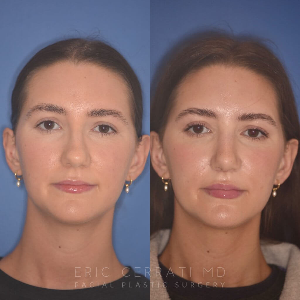 24 YR - 2 Months Postop: Rhinoplasty