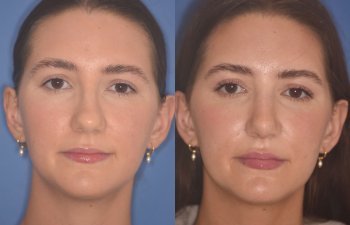 24 YR - 2 Months Postop: Rhinoplasty