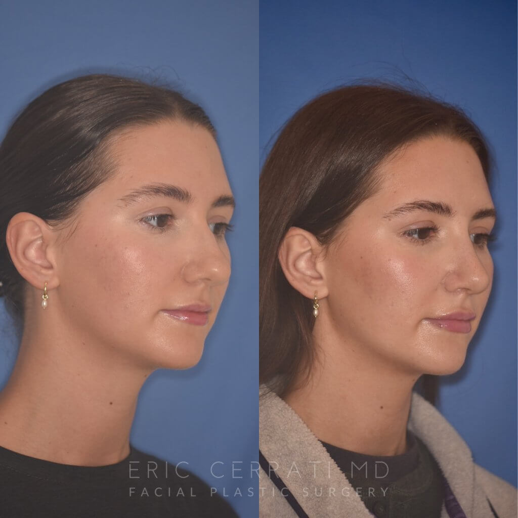 24 YR - 2 Months Postop: Rhinoplasty