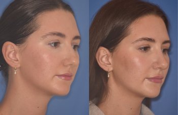 24 YR - 2 Months Postop: Rhinoplasty