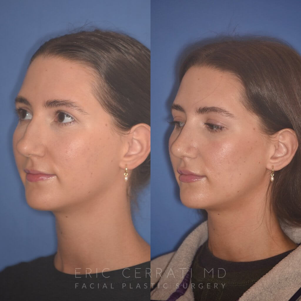 24 YR - 2 Months Postop: Rhinoplasty