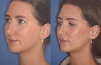 24 YR - 2 Months Postop: Rhinoplasty