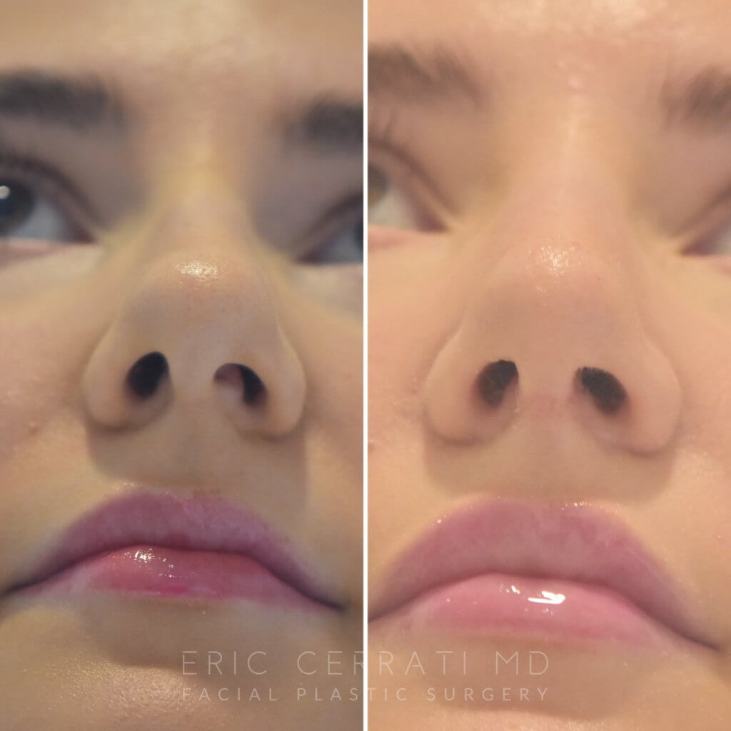 24 YR - 2 Months Postop: Rhinoplasty