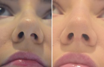 24 YR - 2 Months Postop: Rhinoplasty