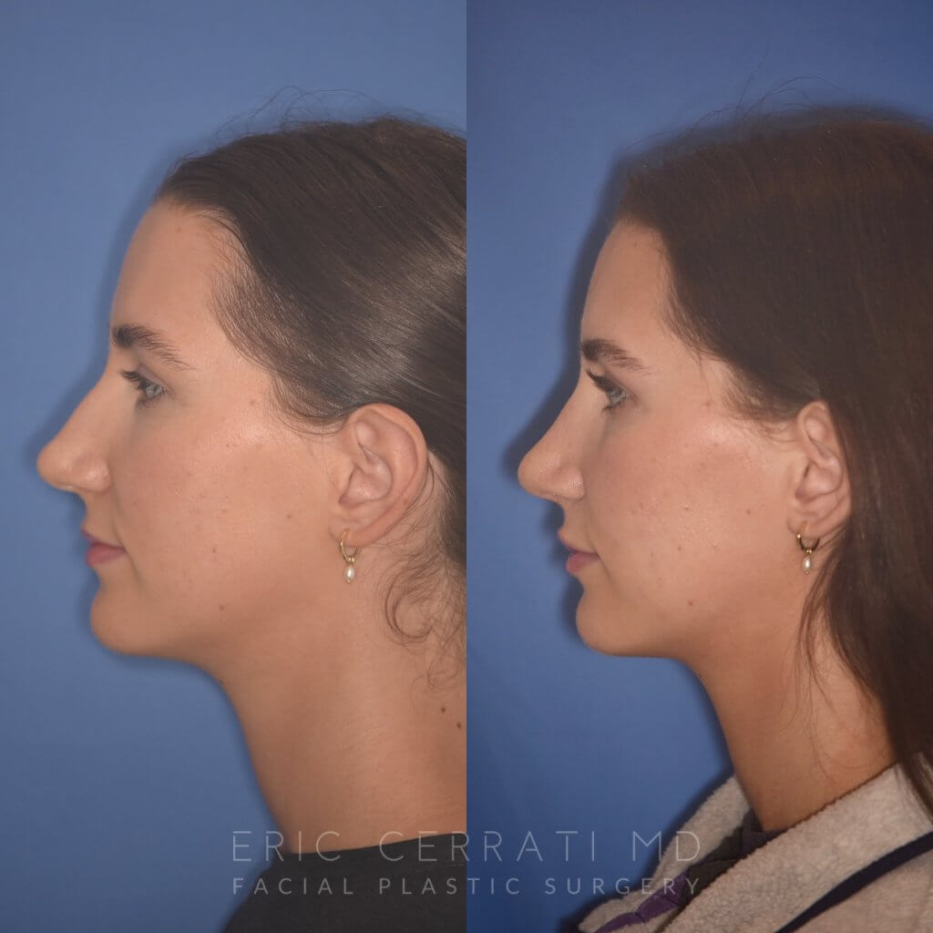 24 YR - 2 Months Postop: Rhinoplasty