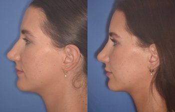 24 YR - 2 Months Postop: Rhinoplasty