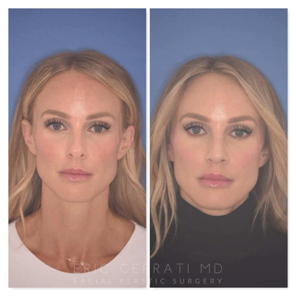41 YR patient - 2 Months Postop: Rhinoplasty before and after photo front