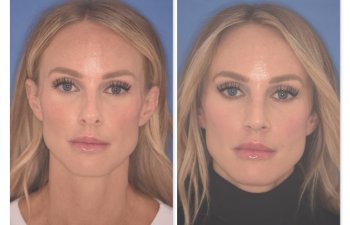 41 YR patient - 2 Months Postop: Rhinoplasty before and after photo front