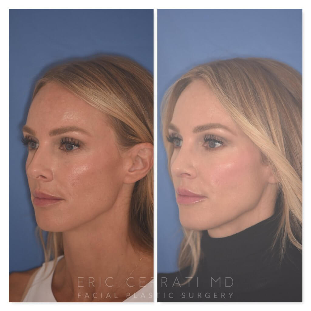 41 YR patient - 2 Months Postop: Rhinoplasty before and after photo left