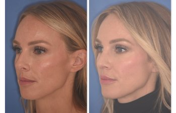 41 YR patient - 2 Months Postop: Rhinoplasty before and after photo left