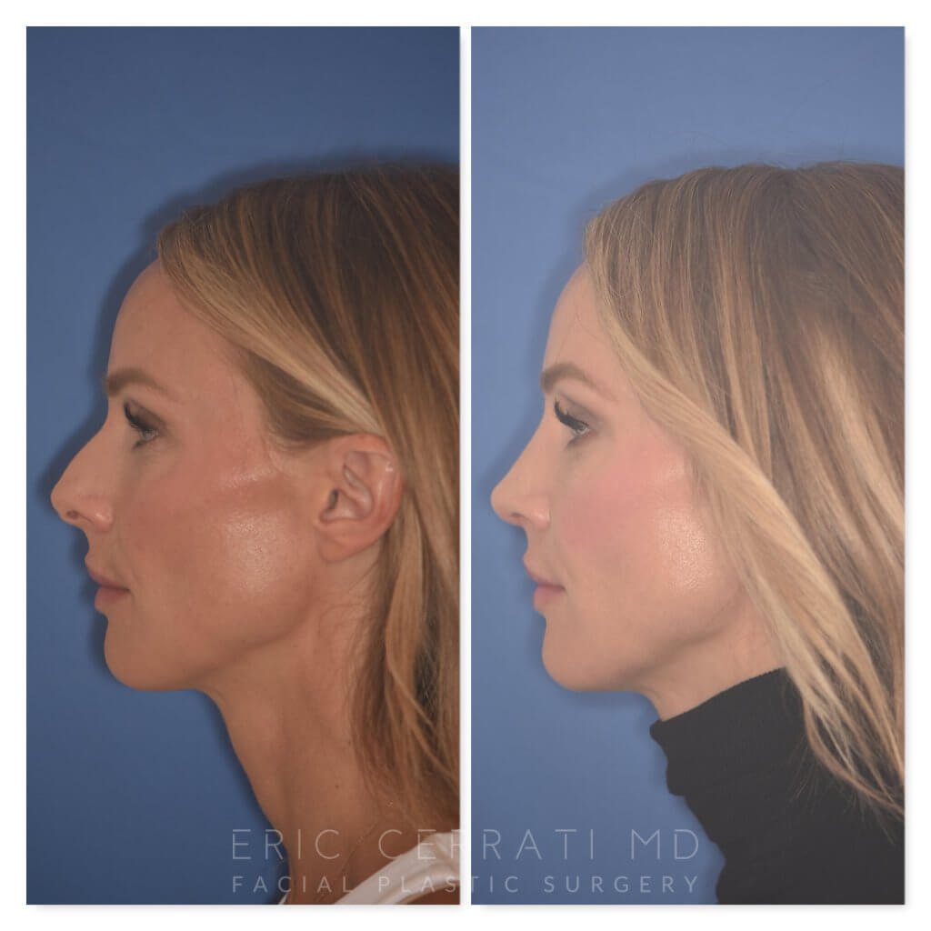 41 YR patient - 2 Months Postop: Rhinoplasty before and after photo left