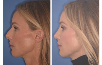 41 YR patient - 2 Months Postop: Rhinoplasty before and after photo left