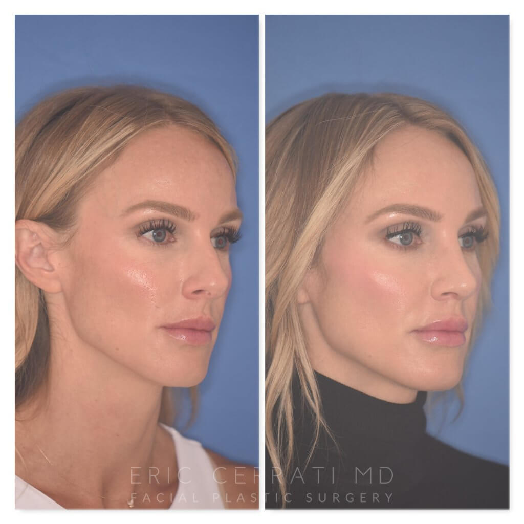 41 YR patient - 2 Months Postop: Rhinoplasty before and after photo right