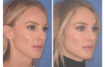 41 YR patient - 2 Months Postop: Rhinoplasty before and after photo right