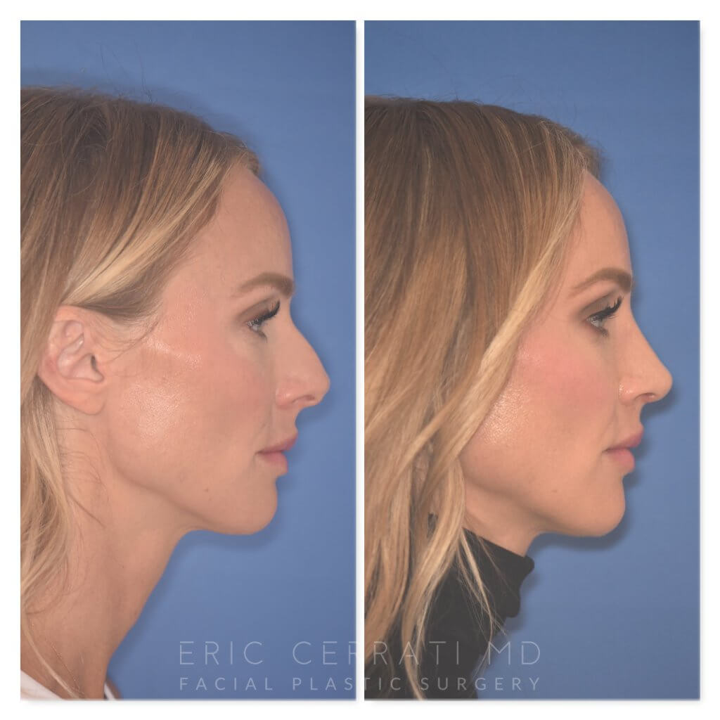 41 YR patient - 2 Months Postop: Rhinoplasty before and after photo right