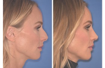 41 YR patient - 2 Months Postop: Rhinoplasty before and after photo right