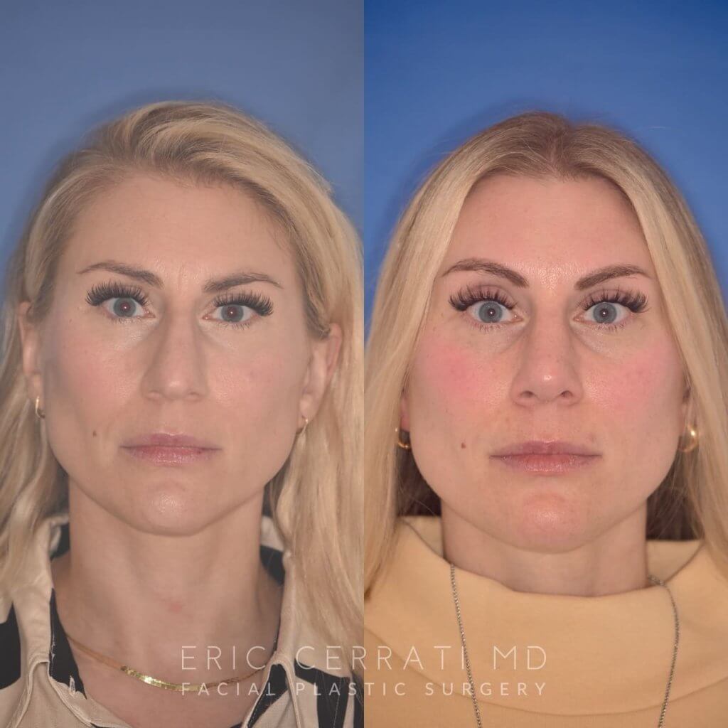 38 YR - 2 Months Postop: Rhinoplasty