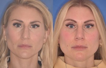 38 YR - 2 Months Postop: Rhinoplasty