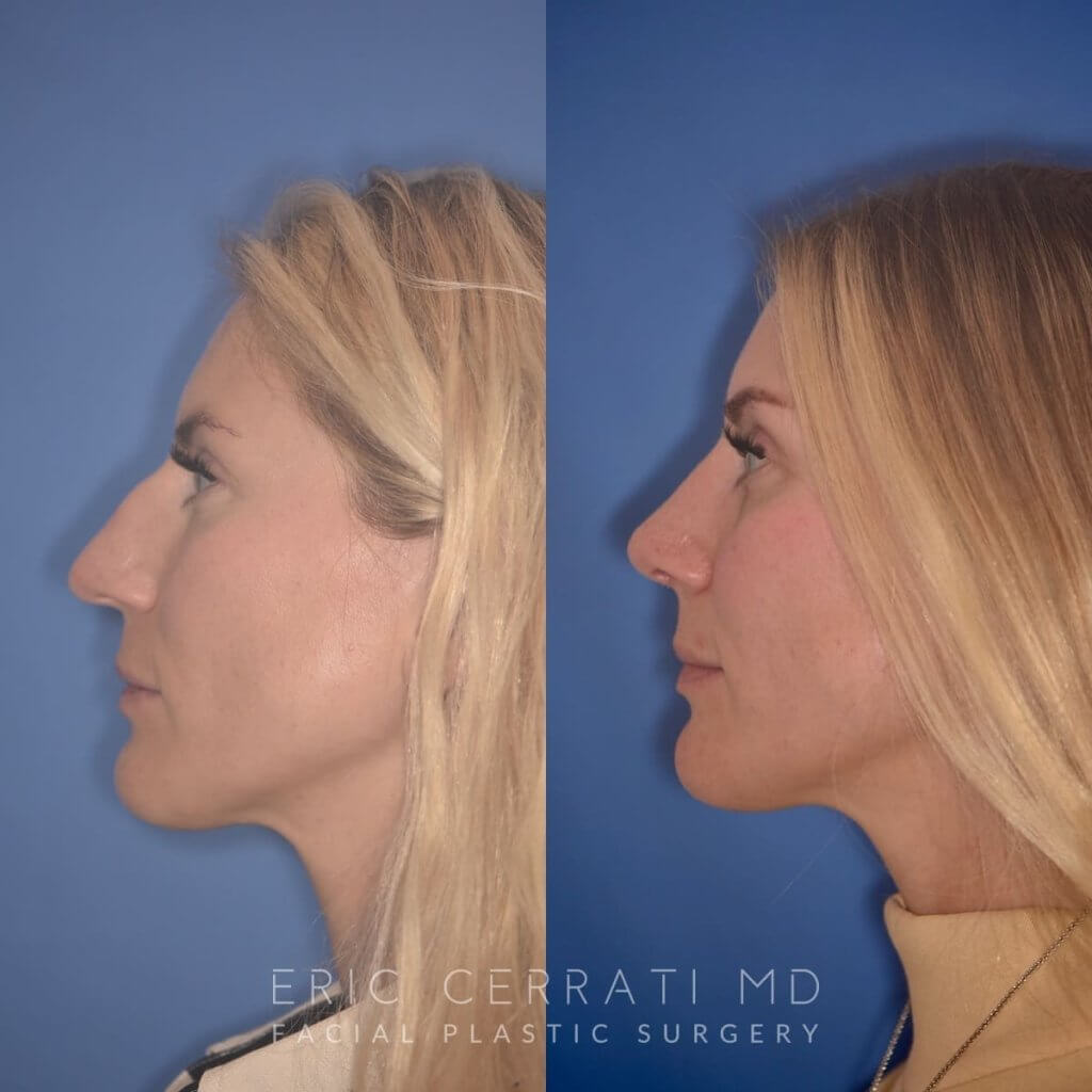 38 YR - 2 Months Postop: Rhinoplasty