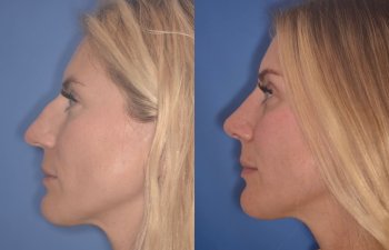 38 YR - 2 Months Postop: Rhinoplasty