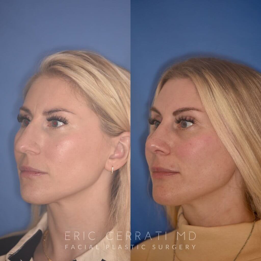 38 YR - 2 Months Postop: Rhinoplasty