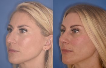 38 YR - 2 Months Postop: Rhinoplasty