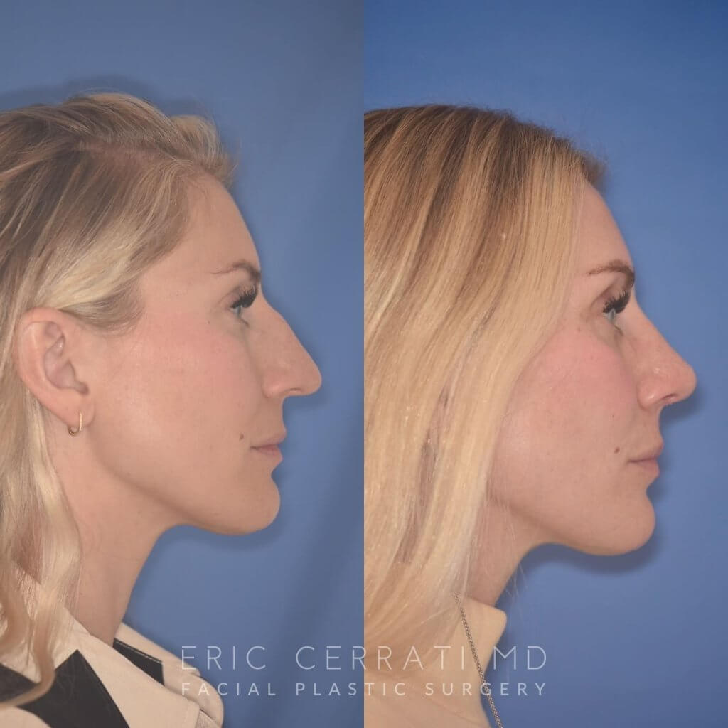 38 YR - 2 Months Postop: Rhinoplasty
