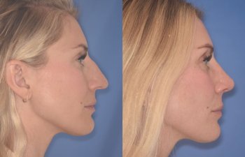 38 YR - 2 Months Postop: Rhinoplasty