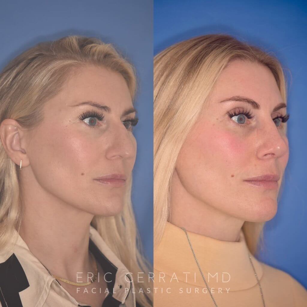 38 YR - 2 Months Postop: Rhinoplasty
