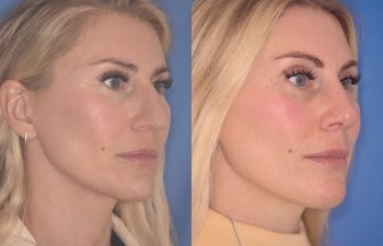 38 YR - 2 Months Postop: Rhinoplasty