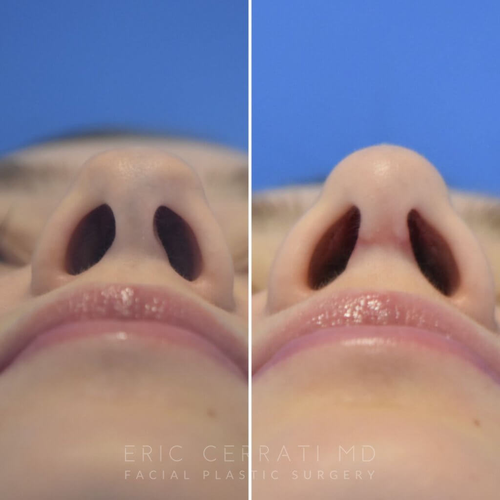 patient before and after rhinoplasty - 24 YR - 2 Months Postop: Rhinoplasty