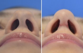 patient before and after rhinoplasty - 24 YR - 2 Months Postop: Rhinoplasty